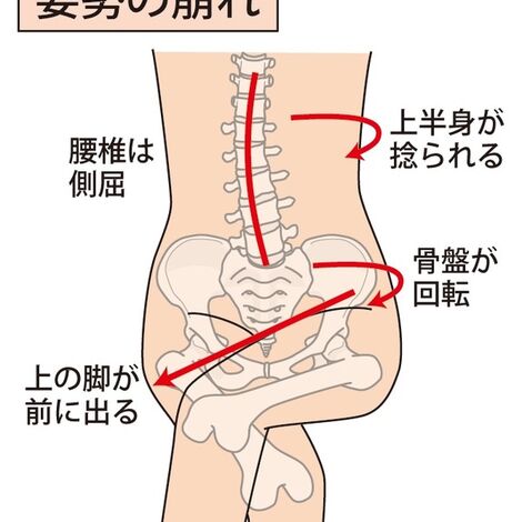 姿勢崩れイラスト.jpeg600PX